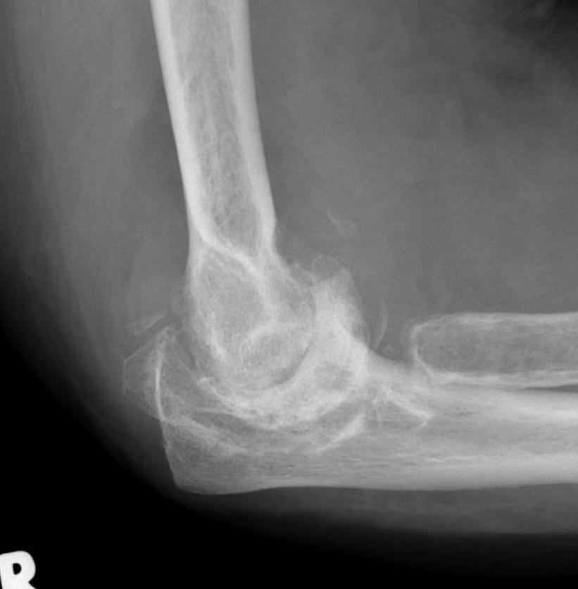 Osteoarthritis & Stiffness The Bone School